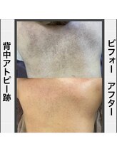 キッカ 梅田天六(Kikka)/背中＊ハーブピーリング