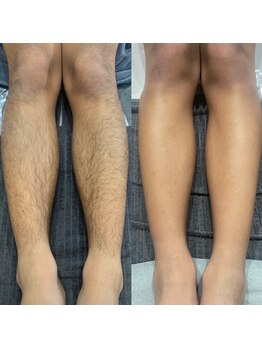 ノノケケ(NONOKEKE)/【メンズ脱毛】　脚脱毛