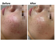 ムーロ バイ ミュー(muro. by mieux)/水光ピール