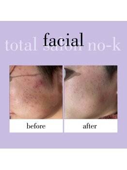 ヌック(NO-K)/光フェイシャル