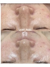 リラクゼーションアンドビューティーボヌール(BONHENR)/最新☆ラミネーションピール