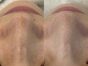 エミナル(Eminal)/◆ハイドラ毛穴洗浄のみ　1回