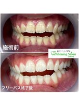 ホワイトニングサロン 名古屋駅店/【ホワイトニング施術例】