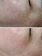 リフュージュ 隠れ家の写真/人気【全顔ハイドラ毛穴フェイシャル×プラズマ】溜まった汚れがスッキリ☆毛穴/シミ/エイジングケアにも◎