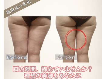 MBF整体/脚の隙間、諦めていませんか?