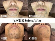 圧倒的効果×痛みの少なさで大人気のメンズ脱毛！お任せ下さい♪