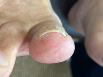 名古屋駅前巻き爪センターの写真/【巻き爪専門店】たった1回の施術で足のお悩みから解放!痛みの少ない施術・爪を切らずに綺麗に巻き爪補正◎