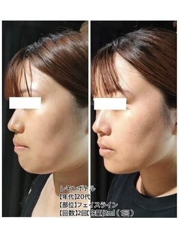 キューティ(Cutie)の写真/レモンボトルで小顔に差がつく！二重アゴ・たるみ・むくみを撃退し、シャープな印象へ☆