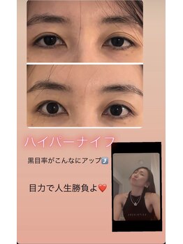 ジーニー(Genie)/ハイパーナイフで？！