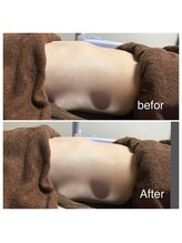 アドネ(Adone)/ラジオ波(上半身)