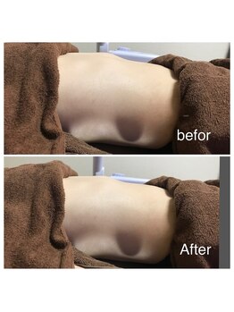 アドネ(Adone)/ラジオ波(上半身)