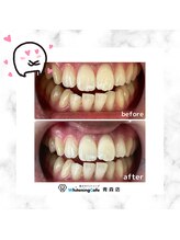 ホワイトニングカフェ 青森店/★お客様の変化