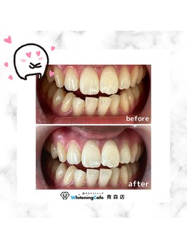 ホワイトニングカフェ 青森店/★お客様の変化