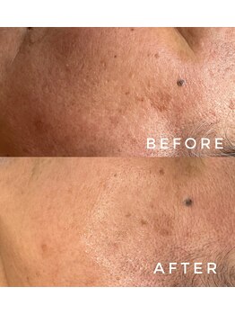 カウニス るる(kaunis)/【ララピール】Before After