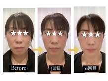 サクラプラス(SAKURA Plus)/肌質革命美顔鍼