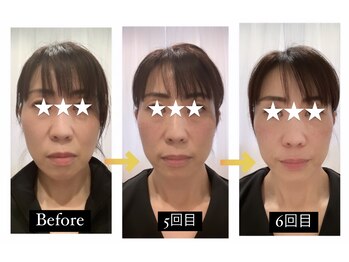 サクラプラス(SAKURA Plus)/肌質革命美顔鍼