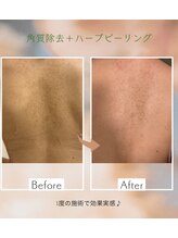 シーアイエステティック 船橋駅前店(c.iエステティック)/背中のハーブピーリング♪