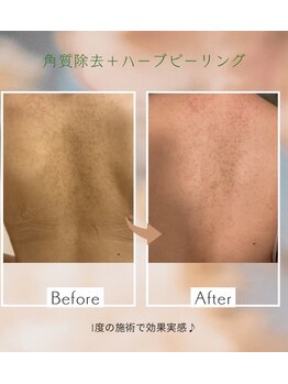 シーアイエステティック 船橋駅前店(c.iエステティック)/背中のハーブピーリング♪