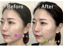 ラプリ 大宮店(Raplit)/隆鼻＋輪郭矯正40分10回