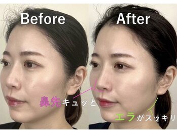 ラプリ 大宮店(Raplit)/隆鼻＋輪郭矯正40分10回