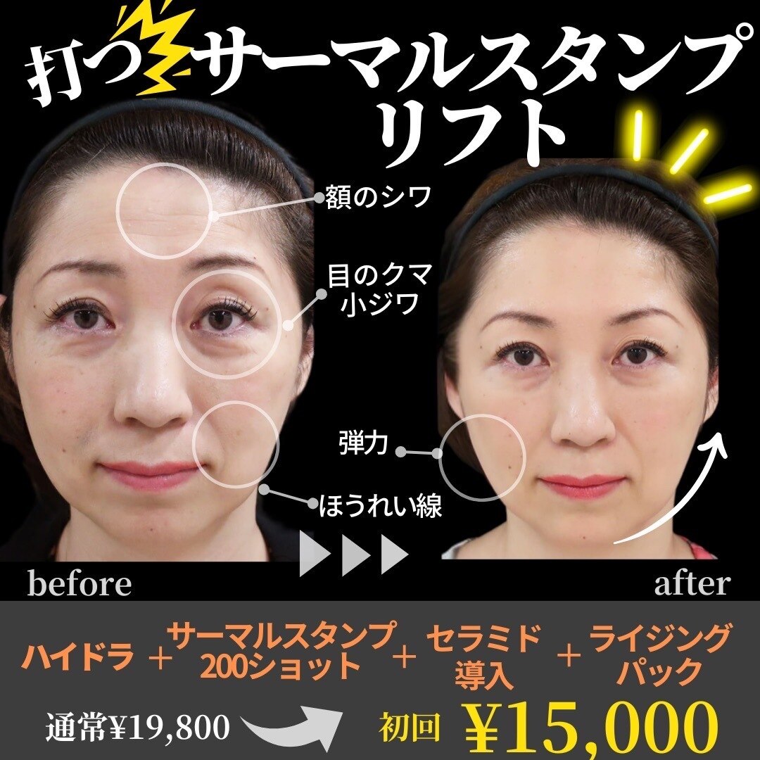 【シワケア弾力】サーマルフラクショナル高周波RF【弾性繊維再生】　60分