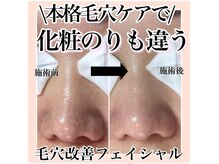 ルネッタ(Lunetta)の雰囲気（頑固な角栓黒ずみを徹底除去して夏前に毛穴をしっかりリセット！）