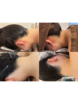 全身脱毛コースのあるサロン