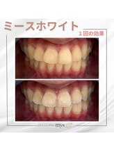 ミースホワイトニング(mys whitening)/ビフォーアフター【歯科提携】