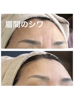 キッカ 梅田天六(Kikka)/眉間のシワ