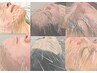 【初回限定3回券/30％オフ！】お肌悩み改善鬼ルート美容鍼33000円→23100円