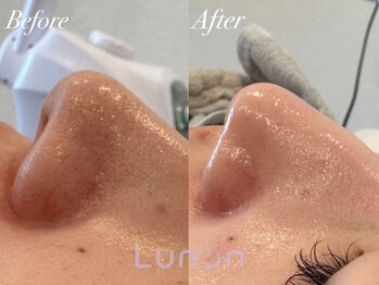 ルノン(Lunon)/毛穴洗浄ハイドロ×ララピール