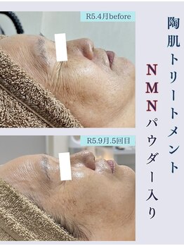 クレヴィー(Creviy)/エイジングケアNo1のNMNパウダー