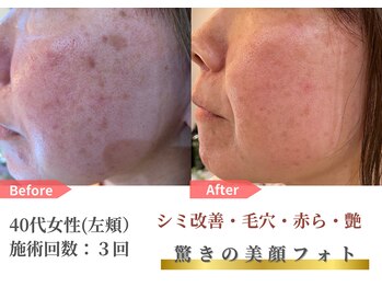 トレース/美顔フォトの効果（40代女性）