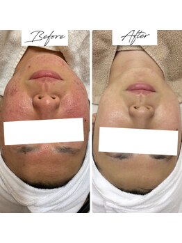 ビズビズ 梅田店(bisebise)/<症例>ニキビケア・赤み跡・毛穴