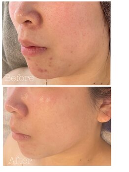 トゥモロー(TOMORROW)/ハーブピーリング/肌質改善