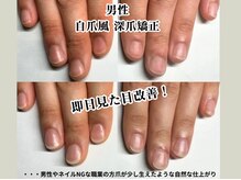 クウ(KUU)/男性深爪矯正　自爪風