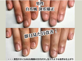 クウ(KUU)/男性深爪矯正 自爪風
