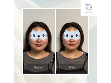 美容鍼＋小顔矯正で、初めてのお客様でも効果が期待できます！