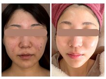 ルルドフォンテ(rurudo fonte.)/ツルツルきれい！大人ニキビ改善