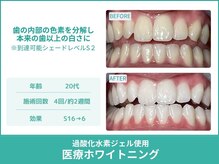 クレア(Crea)/【歯のホワイトニング症例写真】