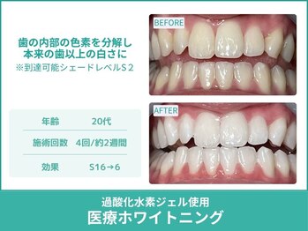 クレア(Crea)/【歯のホワイトニング症例写真】