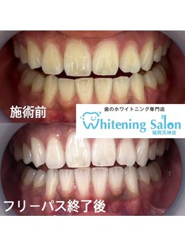 ホワイトニングサロン 福岡天神店の写真/【天神・歯科提携サロン】高い実績口コミエリアTOPレベル!丁寧なカウンセリングでホワイトニング初心者◎