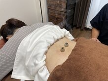 ソラスタ治療院(solasta治療院)/直接身体の上へ置くお灸