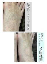 アンジェリーナ/足の甲と指/3回経過/都度払い