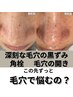 【角栓ゴッソリ!深刻な黒ずみ／固い角栓除去】毛穴エクストラクション120分  