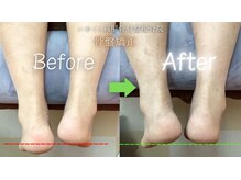 いわくら肩甲骨 骨盤接骨院BTG 一宮千秋/骨盤矯正ビフォーアフター　