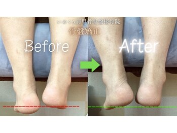 いわくら肩甲骨 骨盤接骨院BTG 一宮千秋/骨盤矯正ビフォーアフター