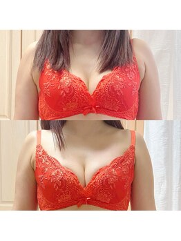 マイン(Mine)/魅せる美バストを叶える施術