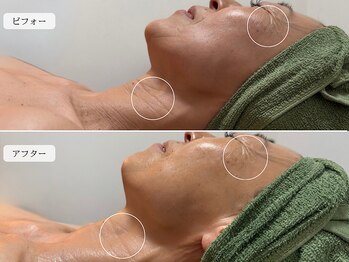 スローガーデン(Slow Garden)/炭酸パックビフォーアフター