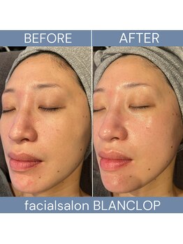 ブランロップ(BLANC LOP)/【ハーブ】内側から素肌を育てる